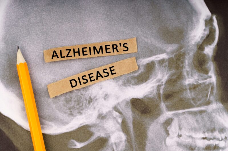 The Man Who Defied Alzheimer’s and Stumped Scientists